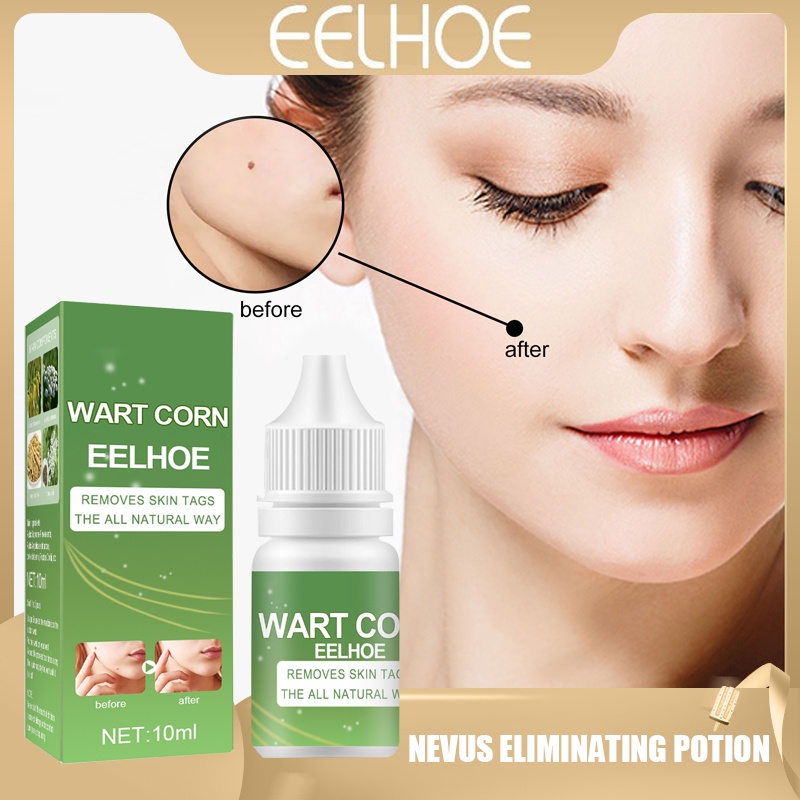 Eelhoe Natural Wart Remover Painlessly Removes Soles Ordinary Soles