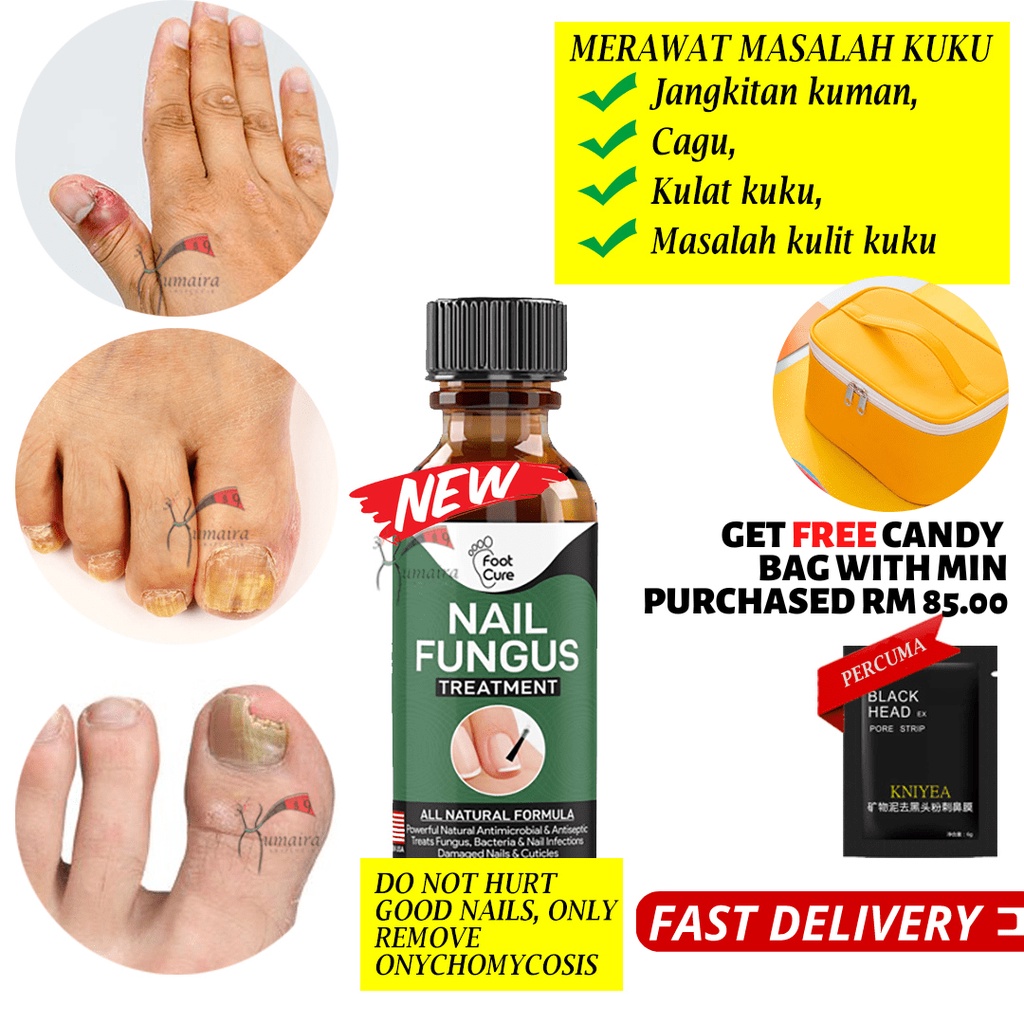 Original Foot Cure Merawat Masalah Penyakit Kuku Cagu Kulat Kuku