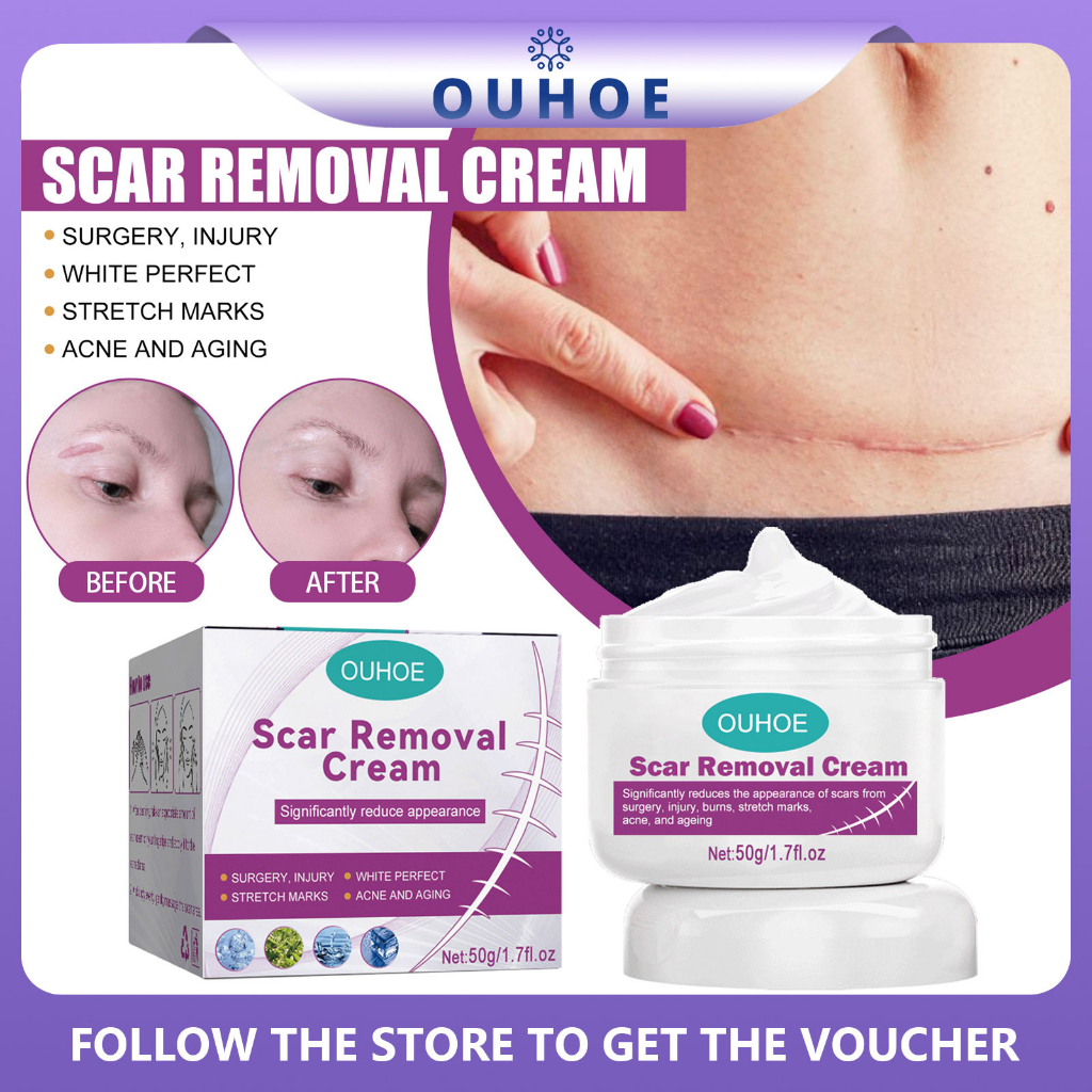 Scar Removal Cream Repair Scars Operation Scald Cream Krim Hilangkan