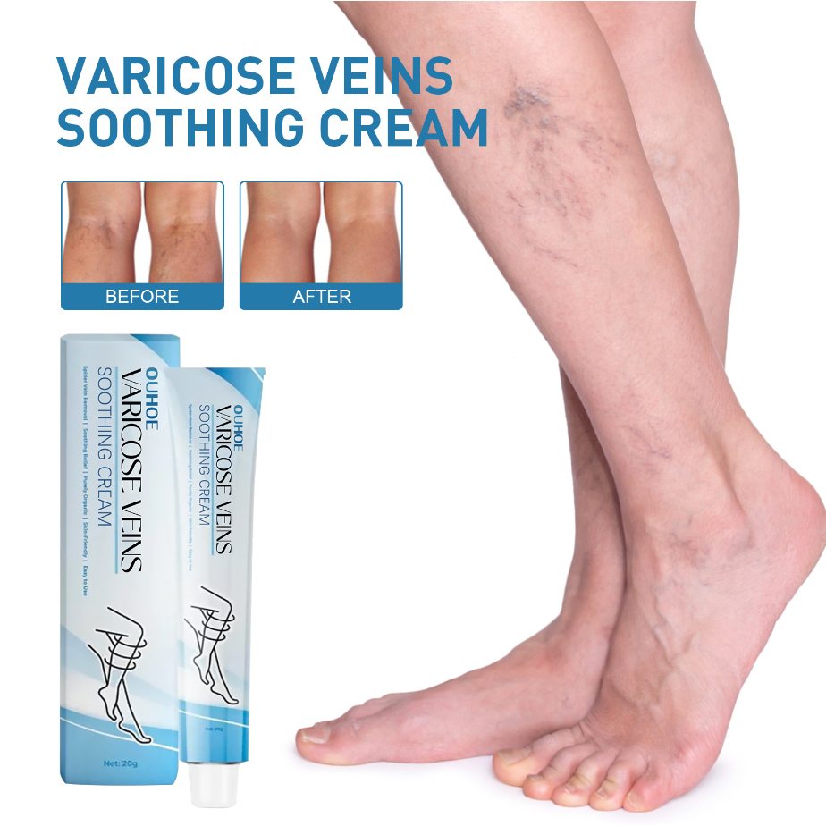 Ouhoe Varicose Veins Soothing Crea Cream Relieve Vasculitis Phlebitis