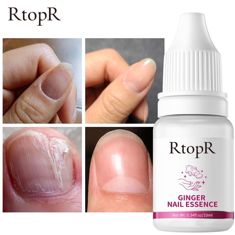 Rtopr Ginger Antibacterial Nail Treatment Anti Onychomycosis Paronychia