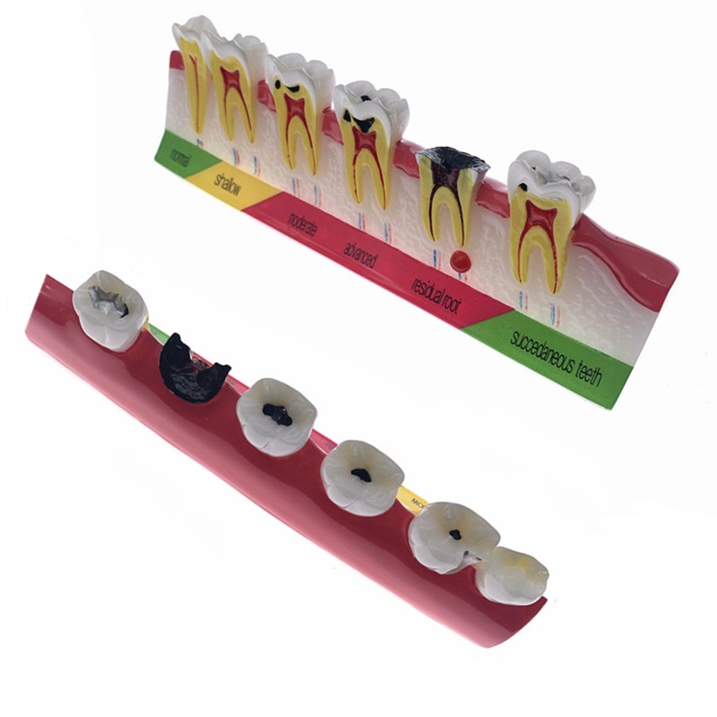 Dental Caries Classify Tooth Model Of Pathological Process Around Teeth