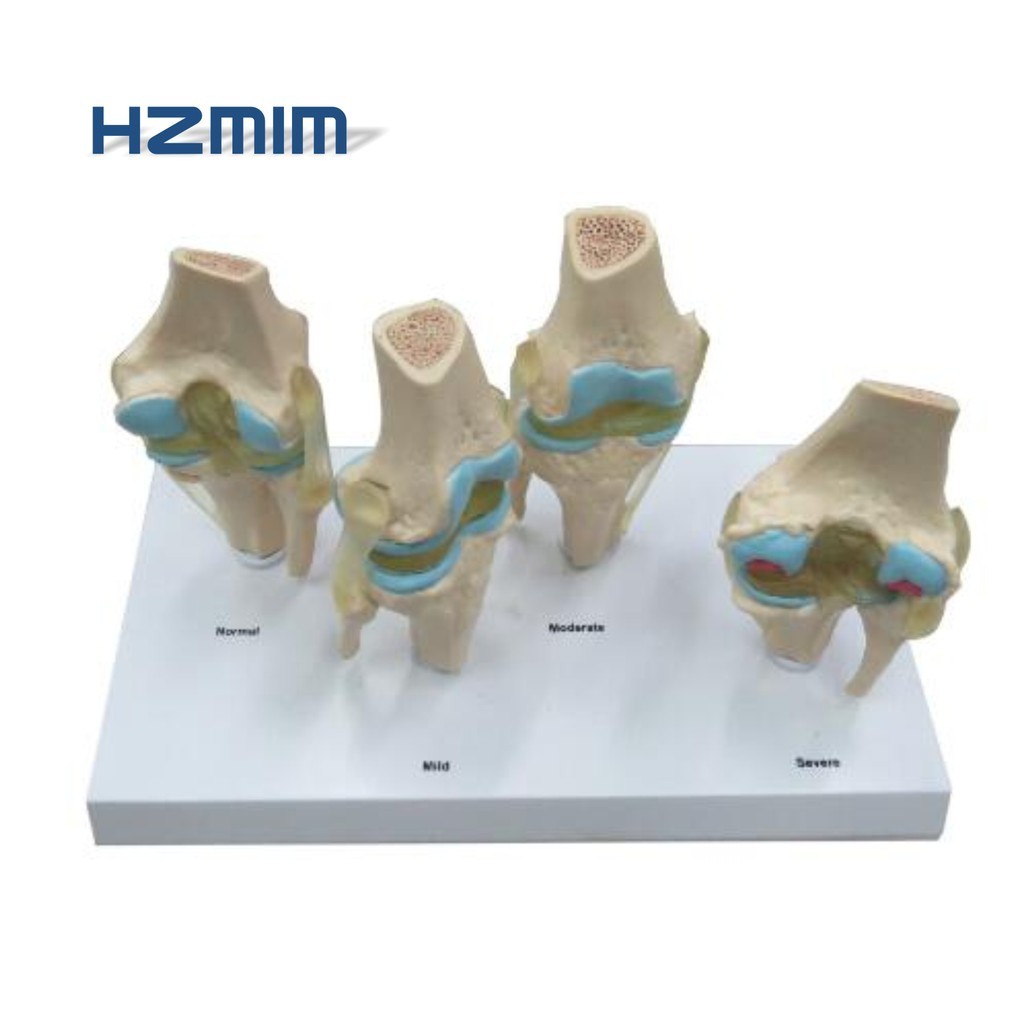 4 Stage Osteoarthritis Knee Model Lesion Knee Joint Model Shopee