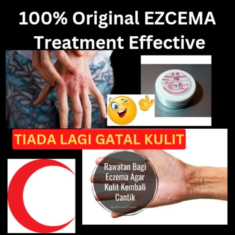 G Eczema Cream Psoriasis Ubat Gatal Kulit Kudis Buta Scabies Kuman