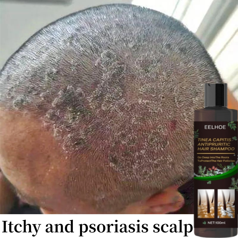 Syampoo Kelemumur Dan Gatal Kepala Psoriasis Scalp Itchy Scalp