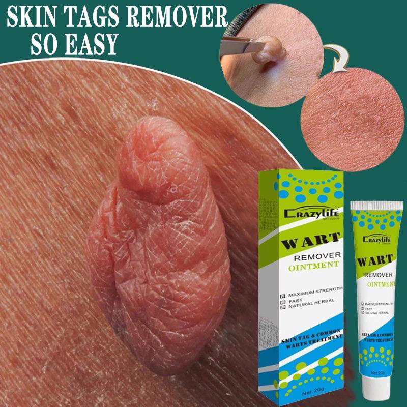 WART REMOVER OINTMENT Cream Skin Tags Remover Hilangkan Tahi Lalat