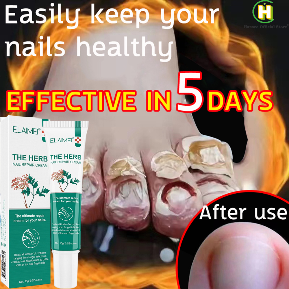 Nail Fungus Cream Nail Repair Cream Onychomycosis Nail Repair Treatment