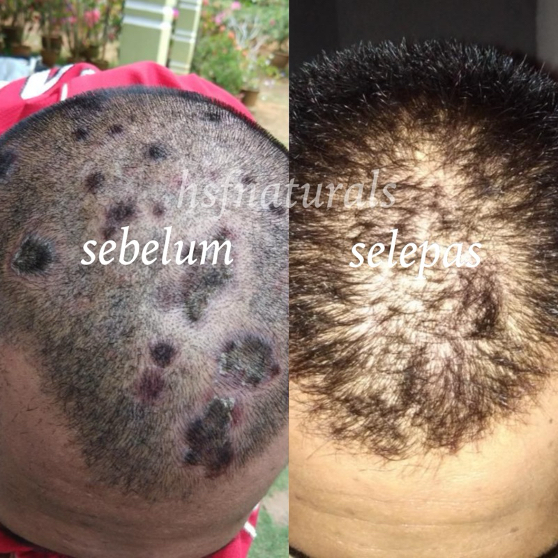 Syampoo Kelemumur Dan Gatal Kepala Anti Dandruff Shampoo Psoriasis