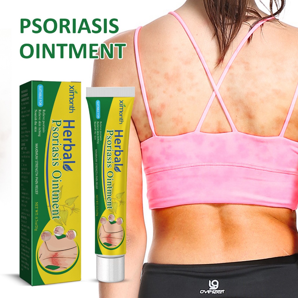 Psoriasis Cream Ubat Gatal Gatal Kulit Quickly Sterilize And Relieve