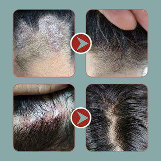 Syampoo Kelemumur Dan Gatal Kepala Psoriasis Scalp Itchy Scalp