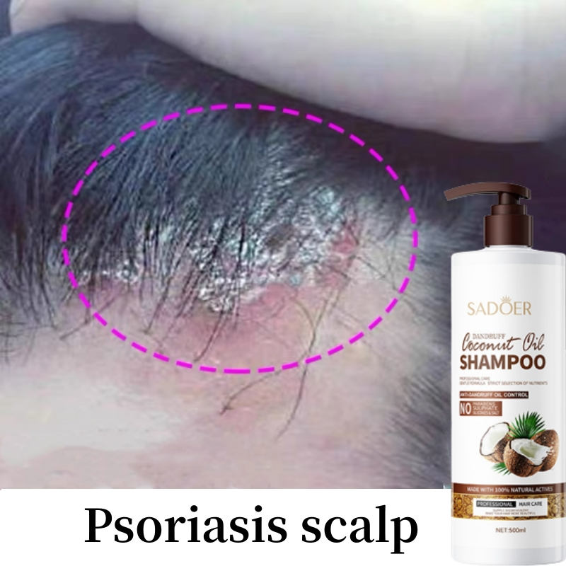 Psoriasis Shampoo Syampoo Kelemumur Dan Gatal Kepala Antifungal Shampoo