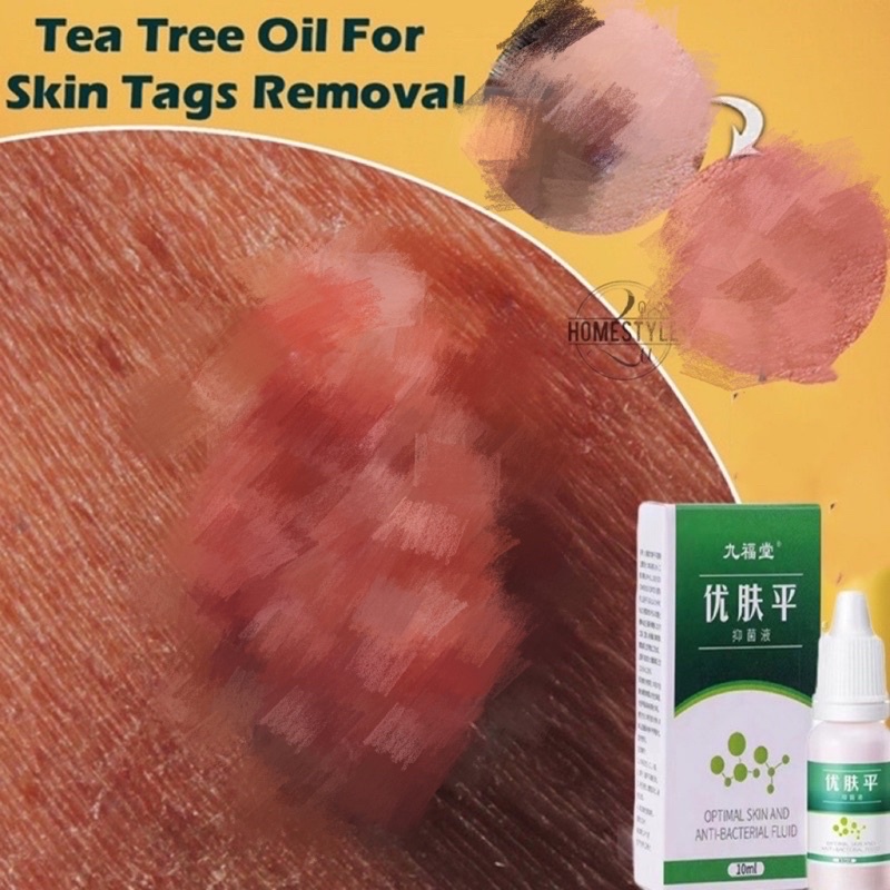 Ubat Buang Kutil Skin Tag Mole Wart Removal Ketuat Tahi Lalat Biji