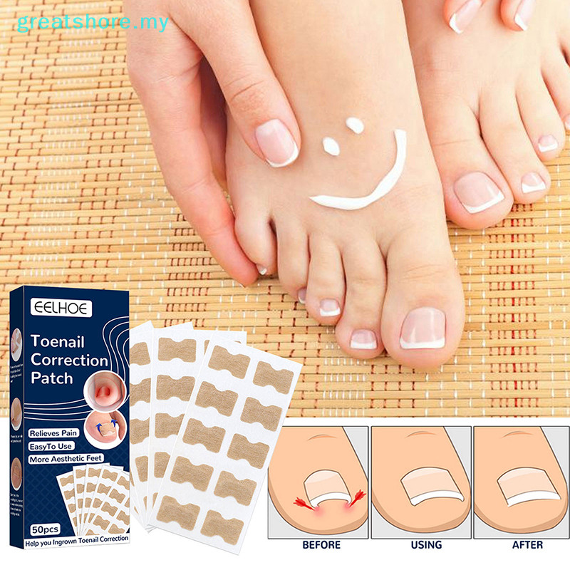 Greatshore 50Pcs Ingrown Toenail Corrector Sticker Nail Strip