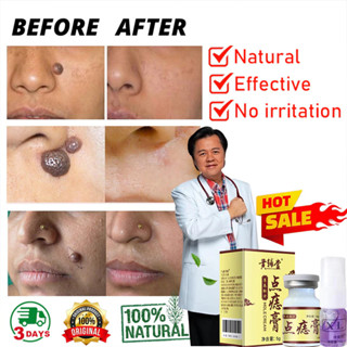 Ubat Kutil Tahi Lalat Ketuat Dan Biji Kolesterol Mole Warts Removal