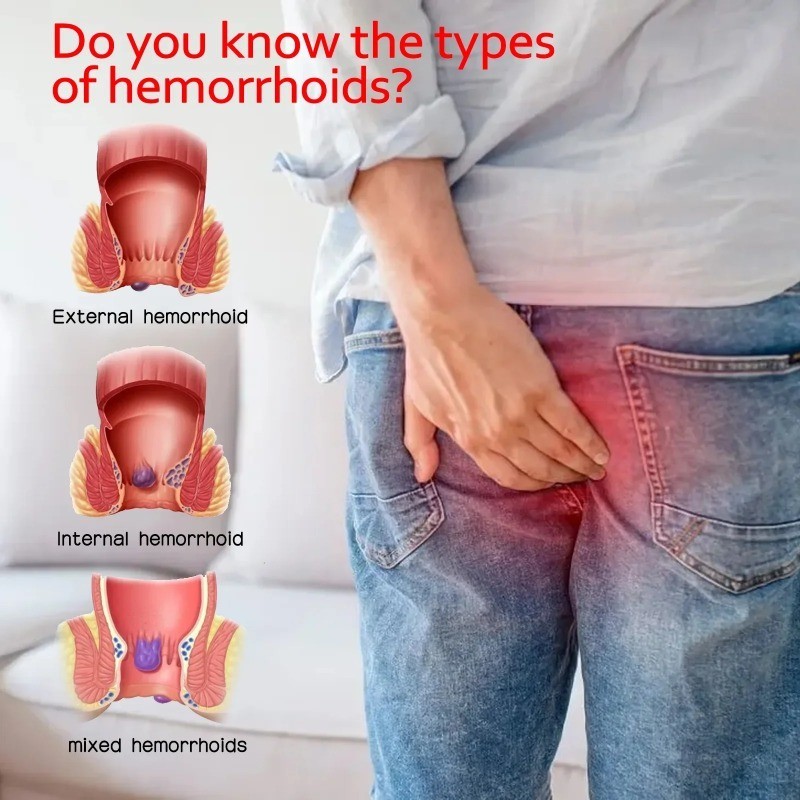 South Moon Hemorrhoids Ointment Internal External Piles Removal Anal