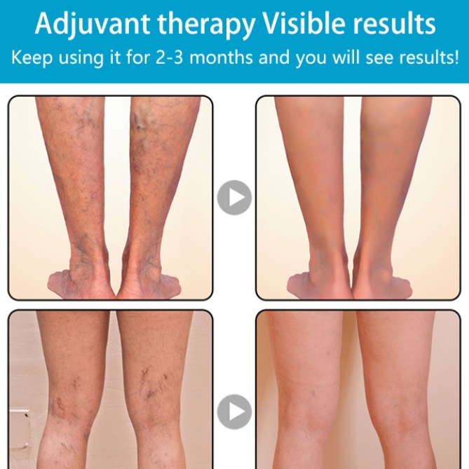 1pair Varicose Veins Socks Treat Phlebitis Vasculitis Compression