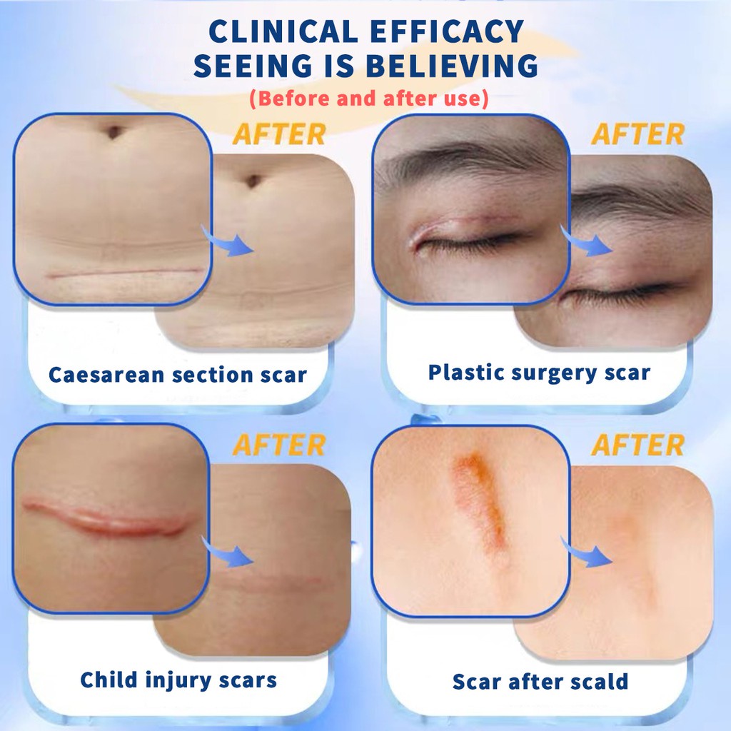 Dermatix Ultra 15g scar silicone gel ointment double eyelid scars