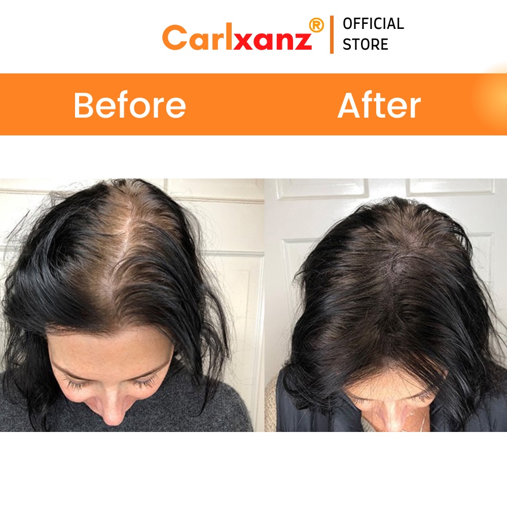Carlxanz Hair Fiber Hide Bald Spot & Thinning Hair (4 x 25g) | Shopee ...