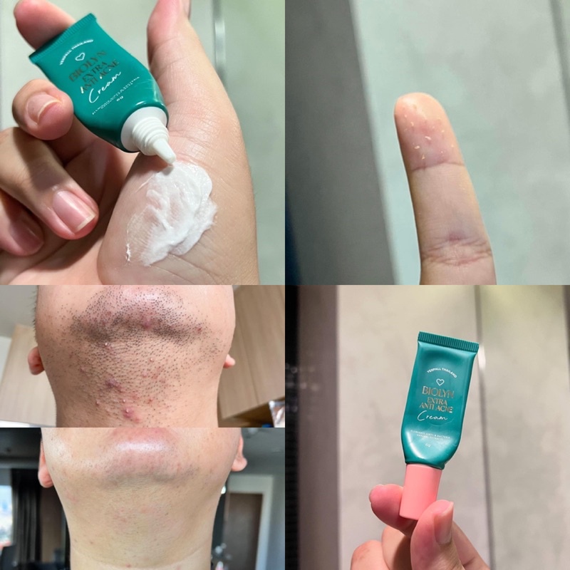 Dissolve acne yerpall Bio Lyn anti cream Original Formula New Package ...