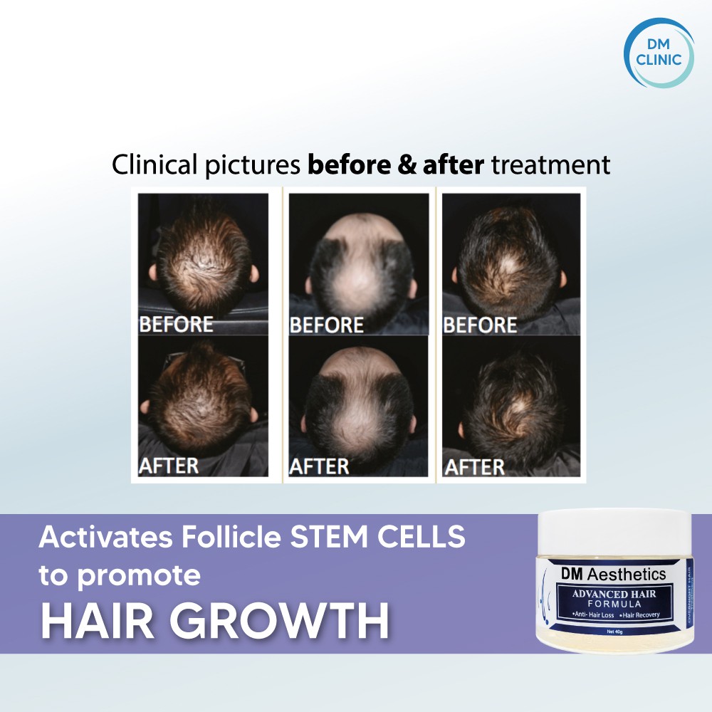 DM Aesthetics ADVANCED HAIR FORMULA(40g) Stimulate Hair Growth + Anti