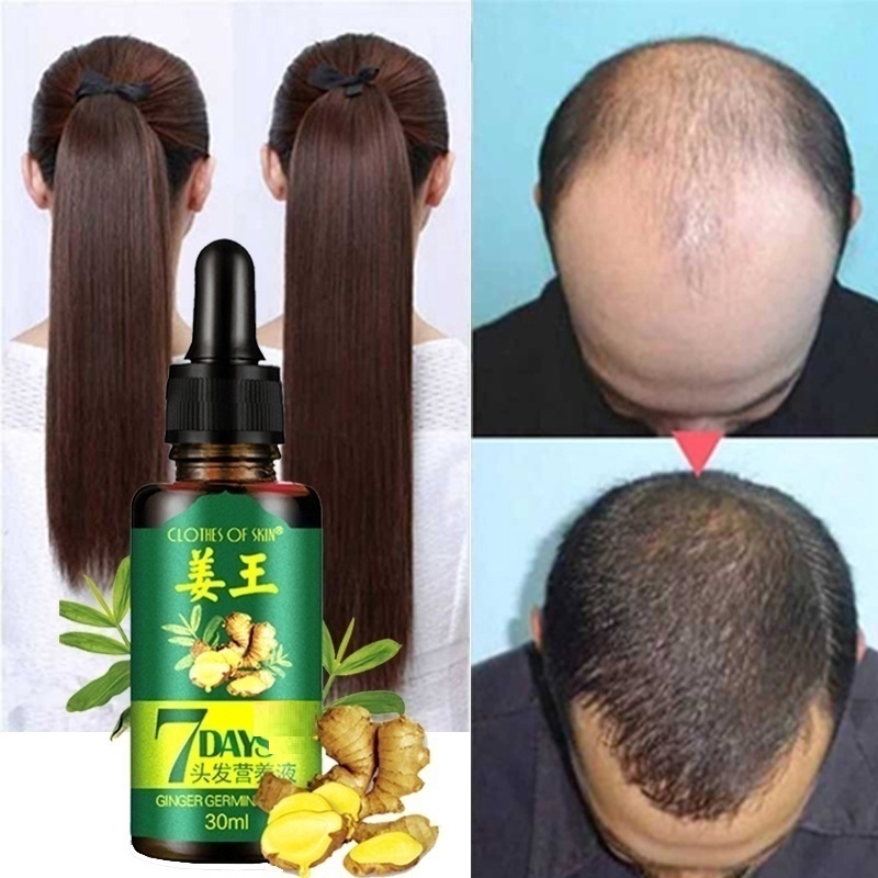 ⚡local Ship⚡ginger King Hair Growth Serum Ginger Hair Growth Tonic Tumbuh Rambut Rambut Gugur 4987