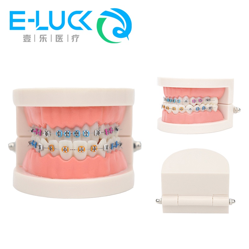 Traditional Braces - Smiles by German Design