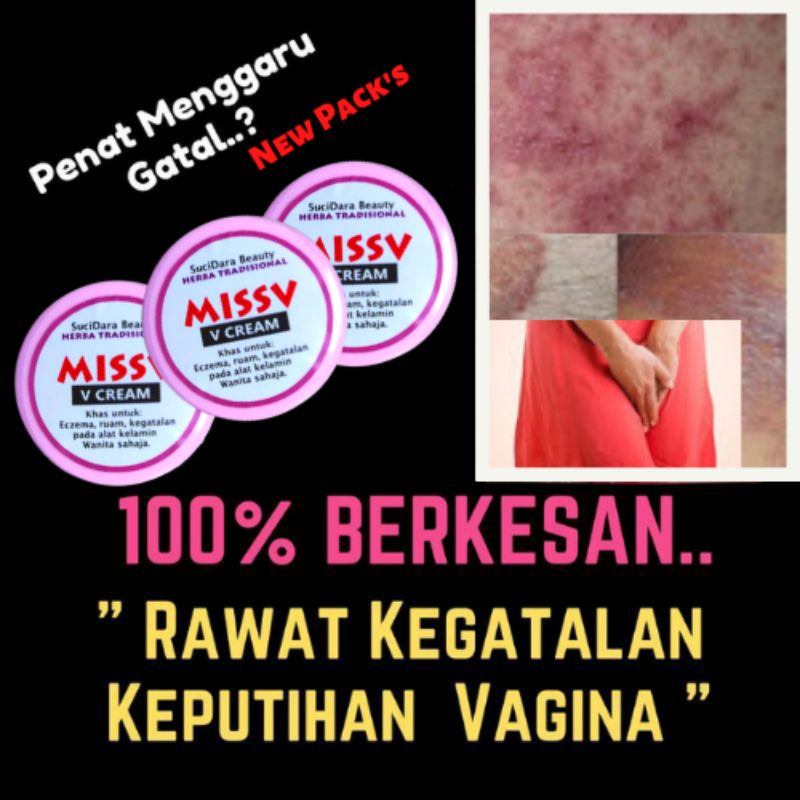 💯 Ubat Keputihan Gatal 💥 Rawat Gatal Celah Peha Seawal 5minit 💥 Ubat Gatal Kemaluan 💥 Miss V 0186