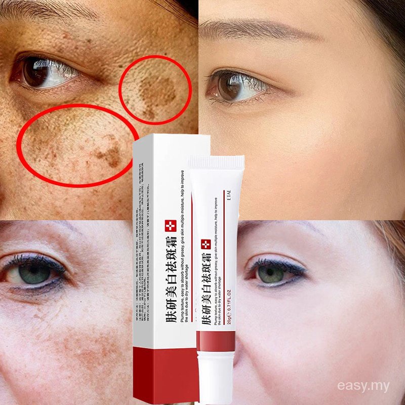 Effective Freckle Cream Remove Dark Spots Witening Cream Fade Acne ...