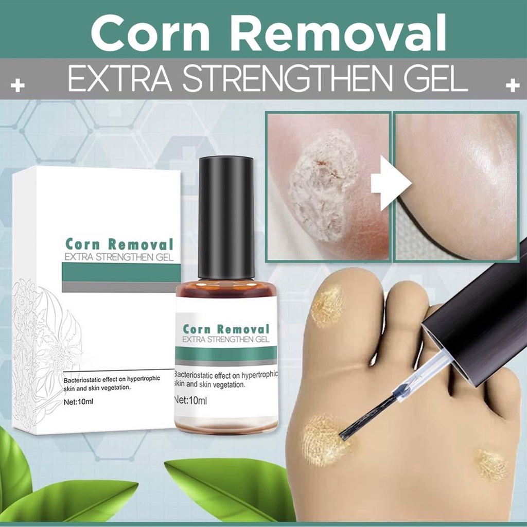 Corns Removal Solution Warts Calluses Removal Solution Warts Thorn ...