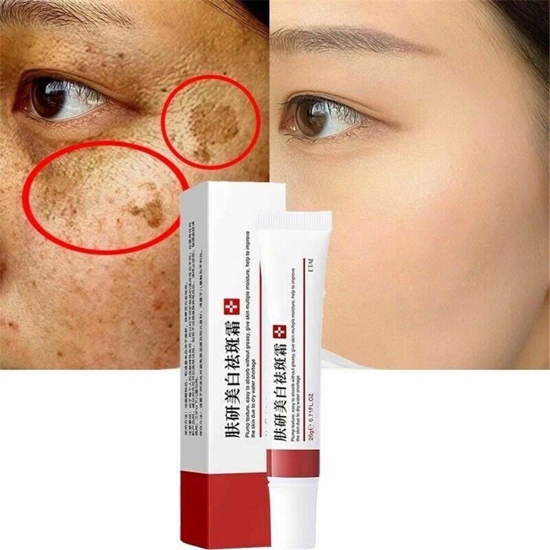 WHITENING FRECKLE CREAM Krim penghilang Jeragat, Bintik hitam melasma
