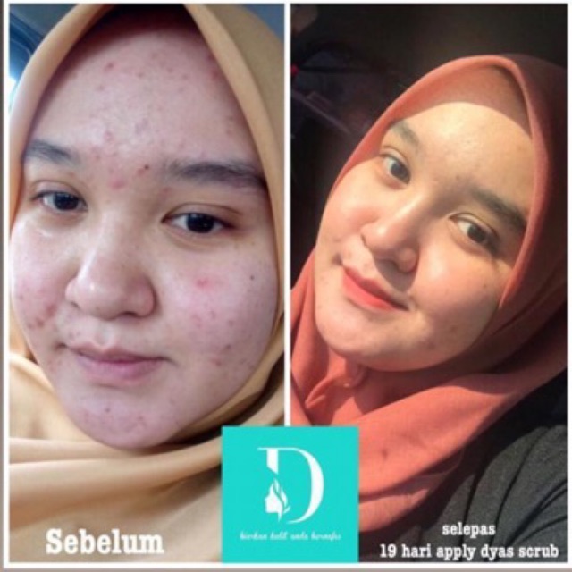 Hot 🔥 Scrub Muka Anti Jerawat Shopee Malaysia