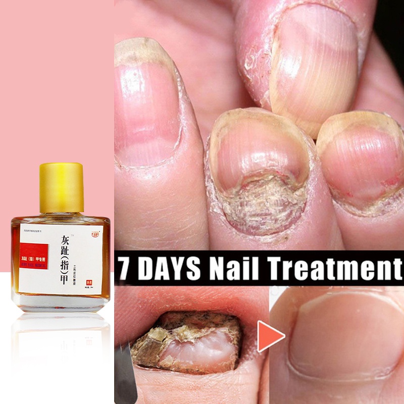 Nail Fungus Treatment Liquid Rawatan Kuku Kaki Kulat Air Kaki Makan Air ...