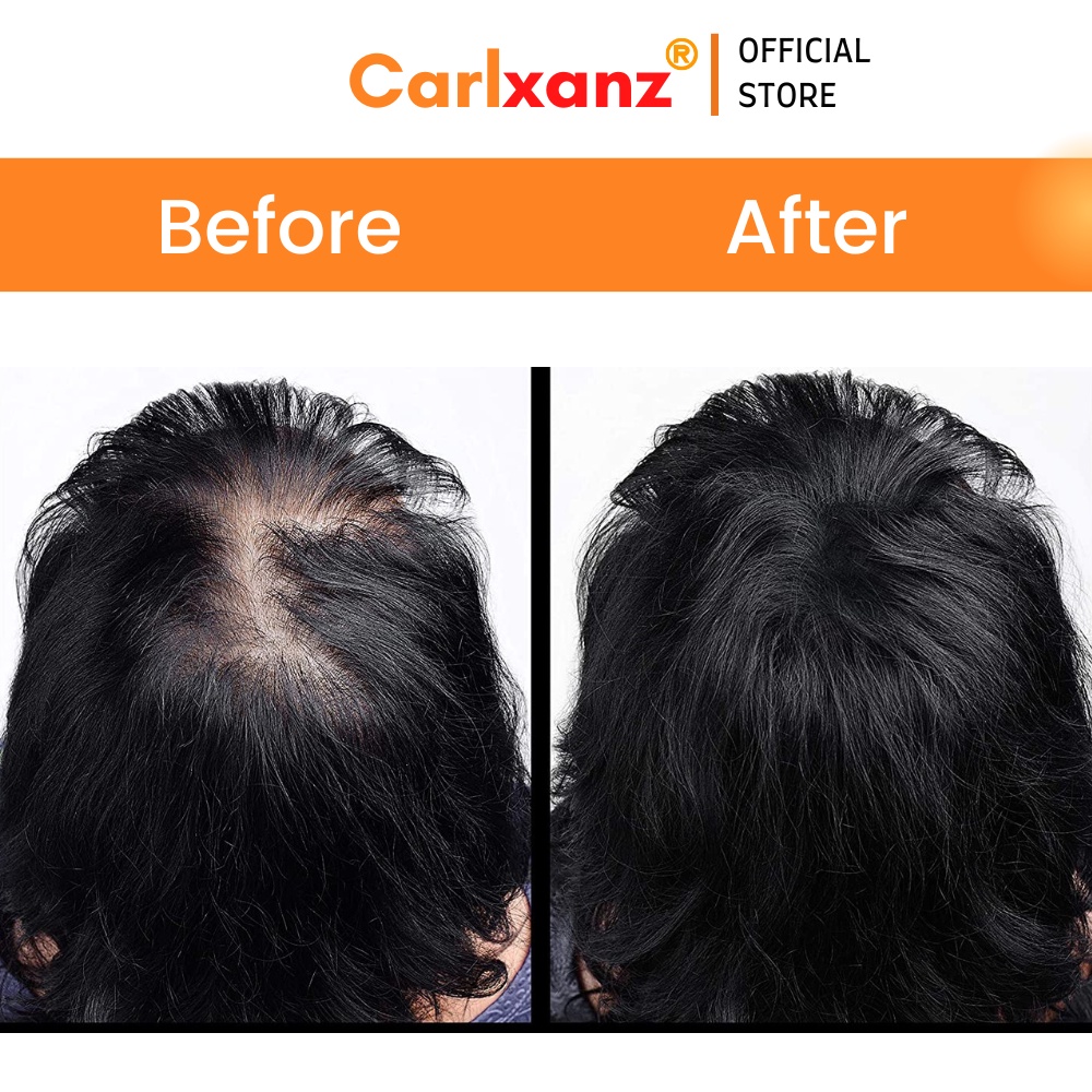 Carlxanz Hair Fiber Hide Bald Spot & Thinning Hair (4 x 25g) | Shopee ...