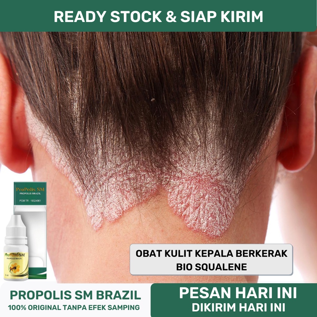 Scalp Medicine, Scalp, Dry, Itching, Scalp Scalp, Scalp, Scalp, Scalp