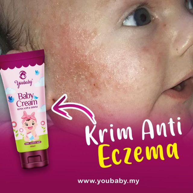 Cream untuk sale baby eczema