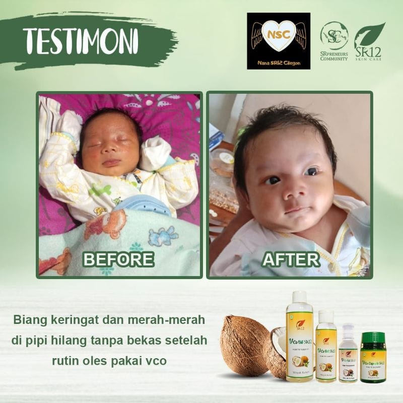 Vco For Babies Itching Medicine Sweat Rash Diapers 100 Herbal