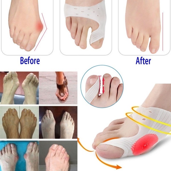2 Pcs Toe Separator Big Toe Orthotics Nursing Thumb Eversion ...