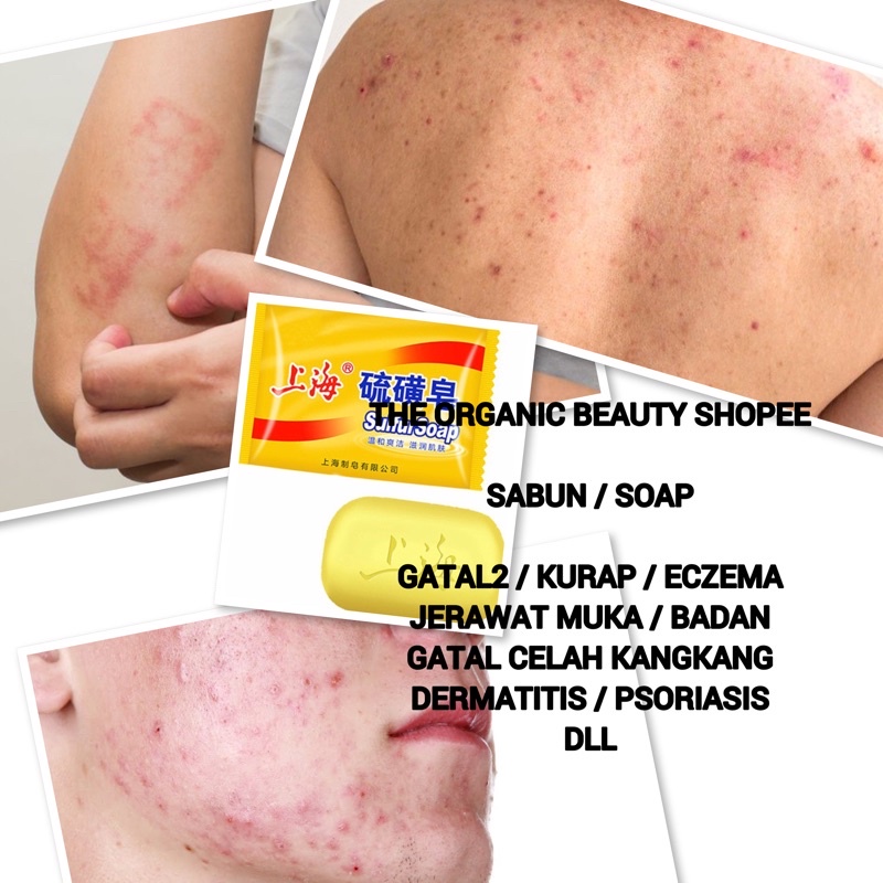 Ready Stock Ubat Gatal Mujarab Ubat Kurap Mujarab Psoriasis