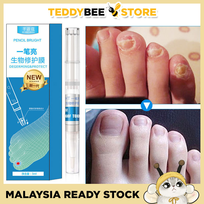 3ml AntiFungal Nail Solution for Toenails & Fingernails Fungus
