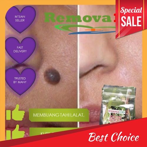 BEST SELLER [ Local Ready Stocks ] REMOVA100 Traditional Natural Mole ...