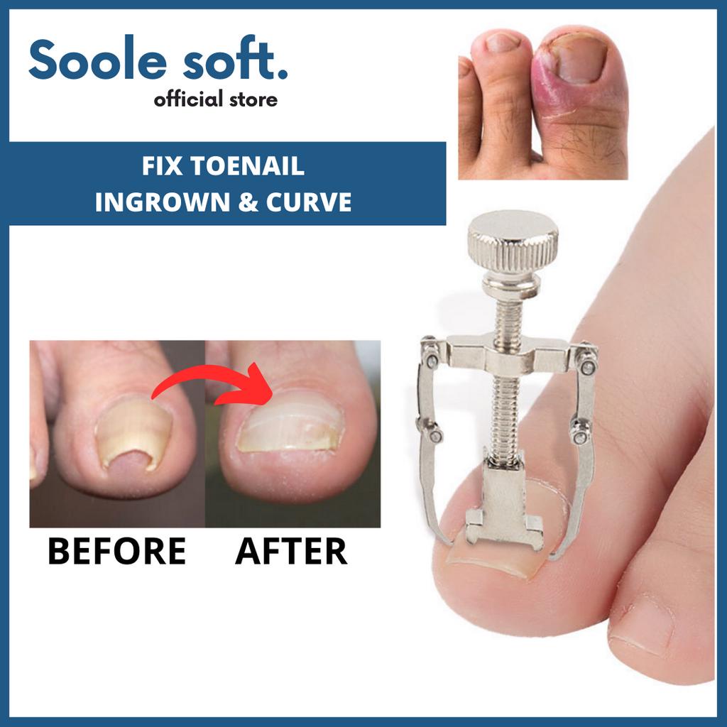𝗦𝗼𝗼𝗹𝗲 𝘀𝗼𝗳𝘁. Ingrown Toenail Corrector Toe Nail Clipper Fixer Remover ...