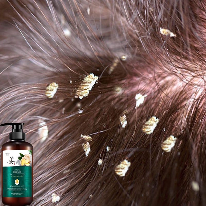 Cara Jaga Kulit Kepala Lelaki – Elak Kelemumur Kronik