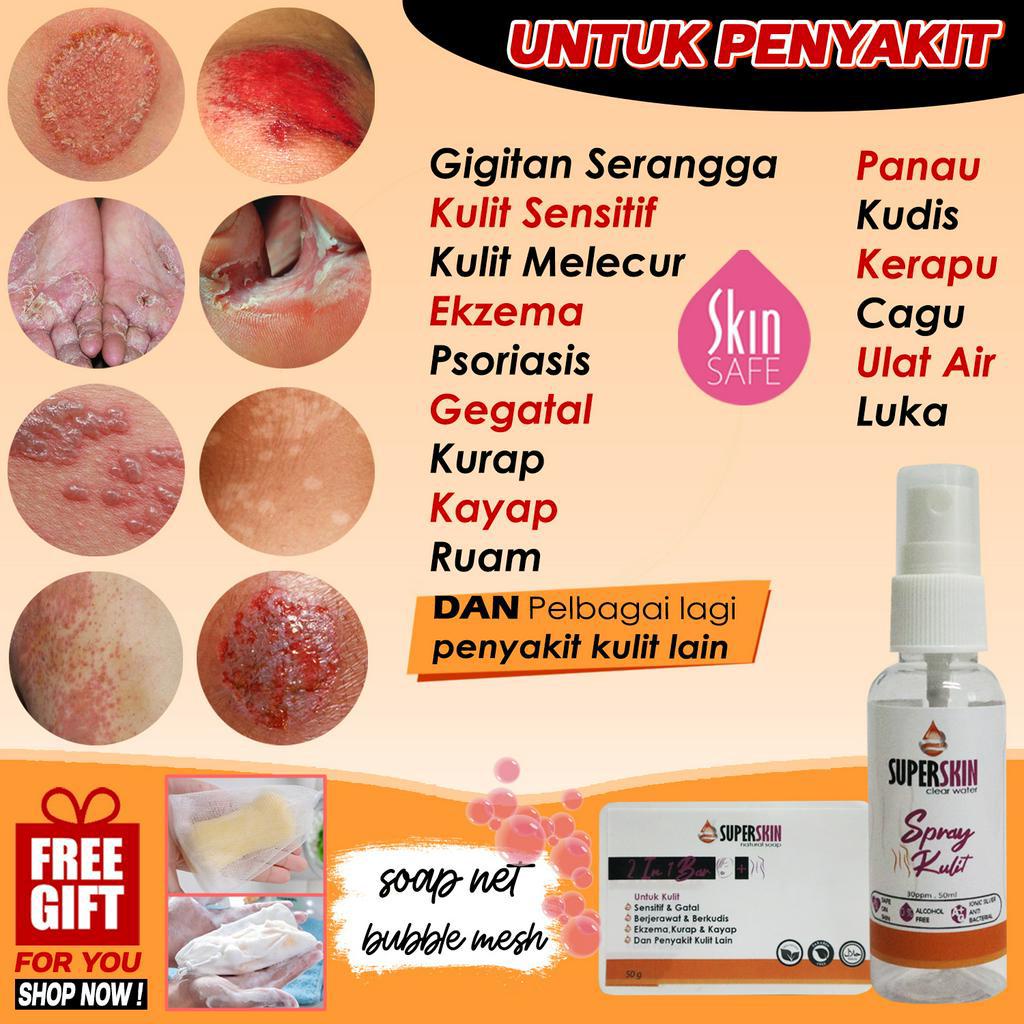 Ubat Gatal Untuk Kulit Kurap Kayap Ruam Ekzema Kudis Psoriasis Scabies