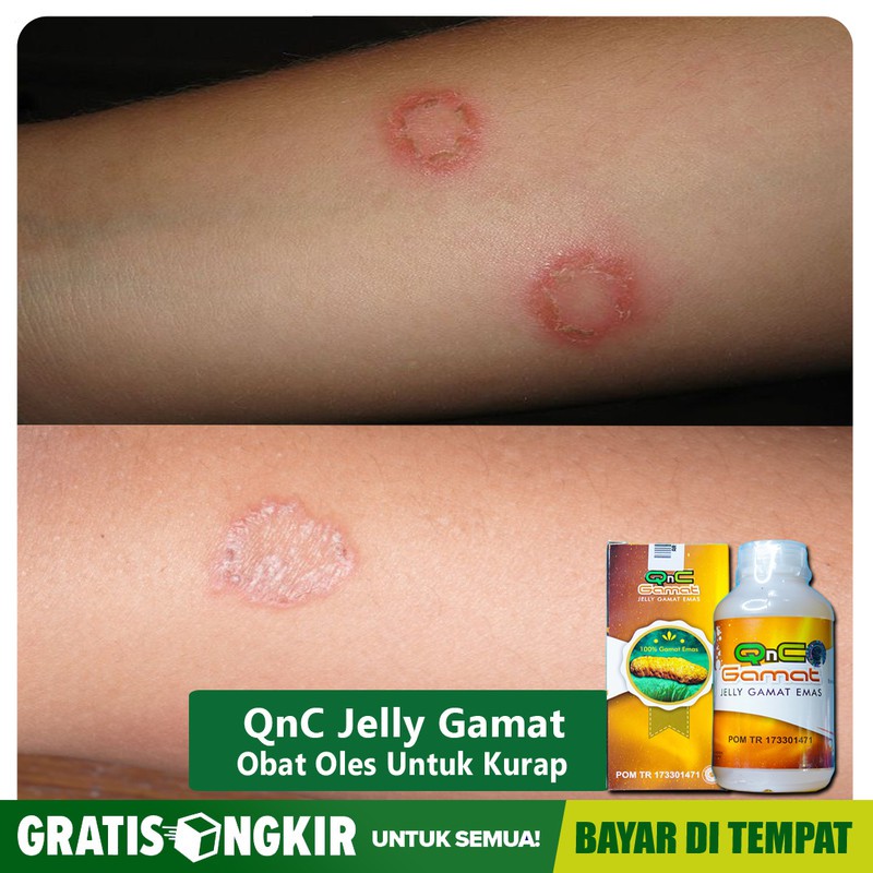 Special Medicine For Ringworm Panu Itching Eczema Fungus Scabies Rash ...