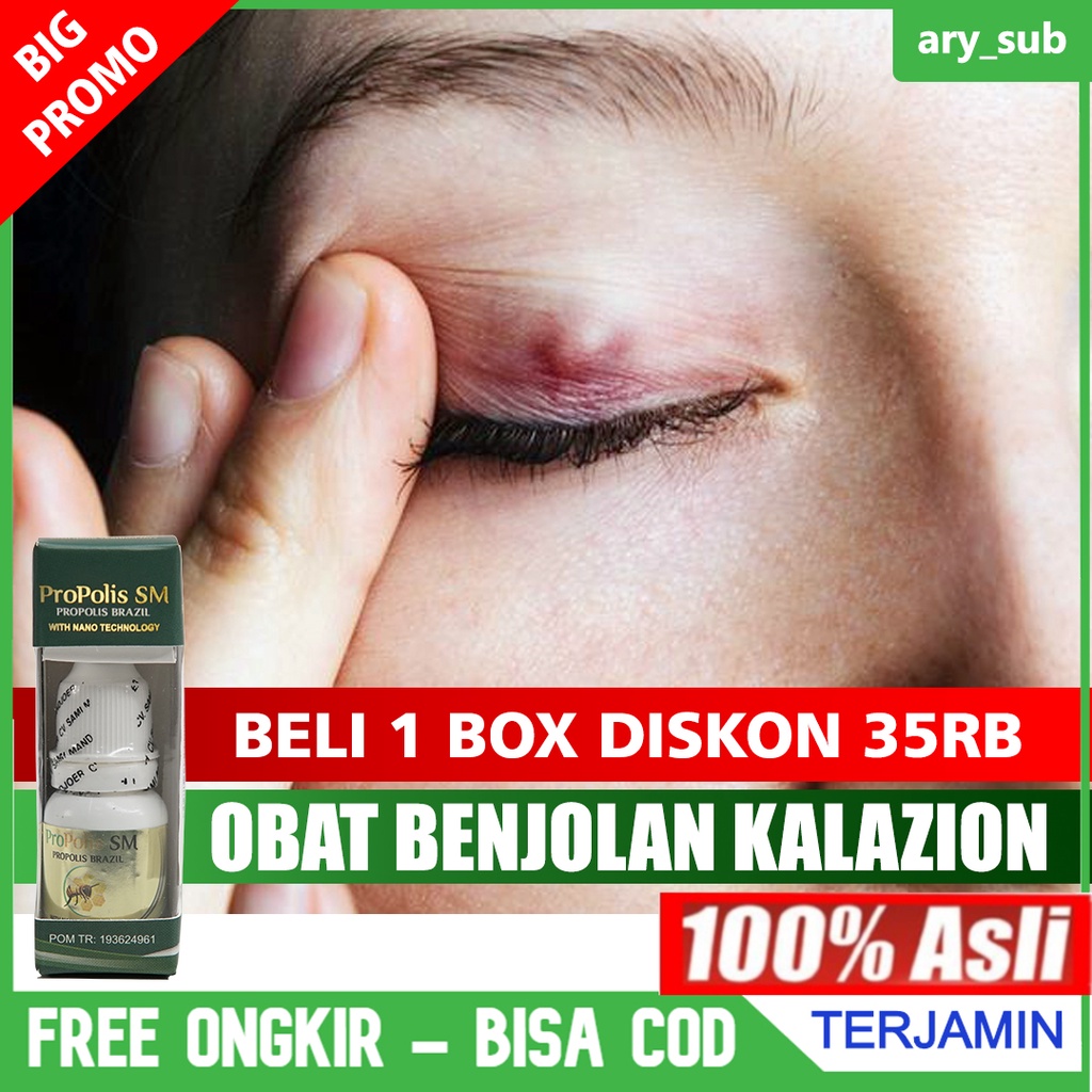 MATA Medicine For Removing Kalazion Bumps, Lumps On The Eyelids ...