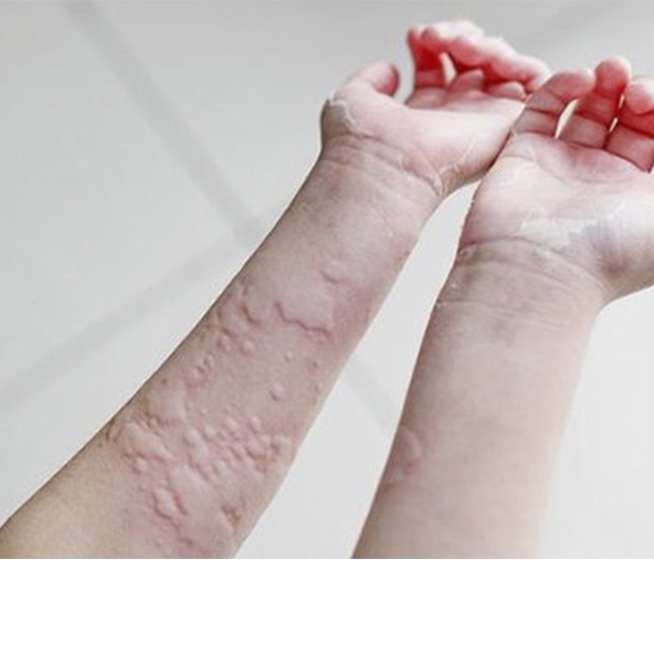 Apply to Eliminate Itching, Rashes, Hives, Skin Rashes, Cold Wind ...