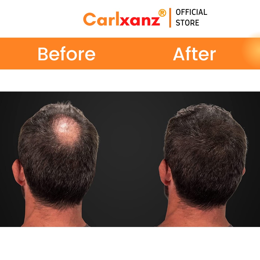 Carlxanz Hair Fiber Hide Bald Spot & Thinning Hair (4 x 25g) | Shopee ...