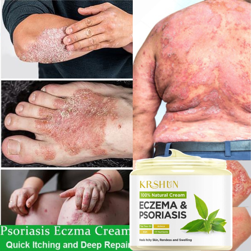 Skin Psoriasis Eczma Cream for All Kinds of Skin Problems Chinese ...