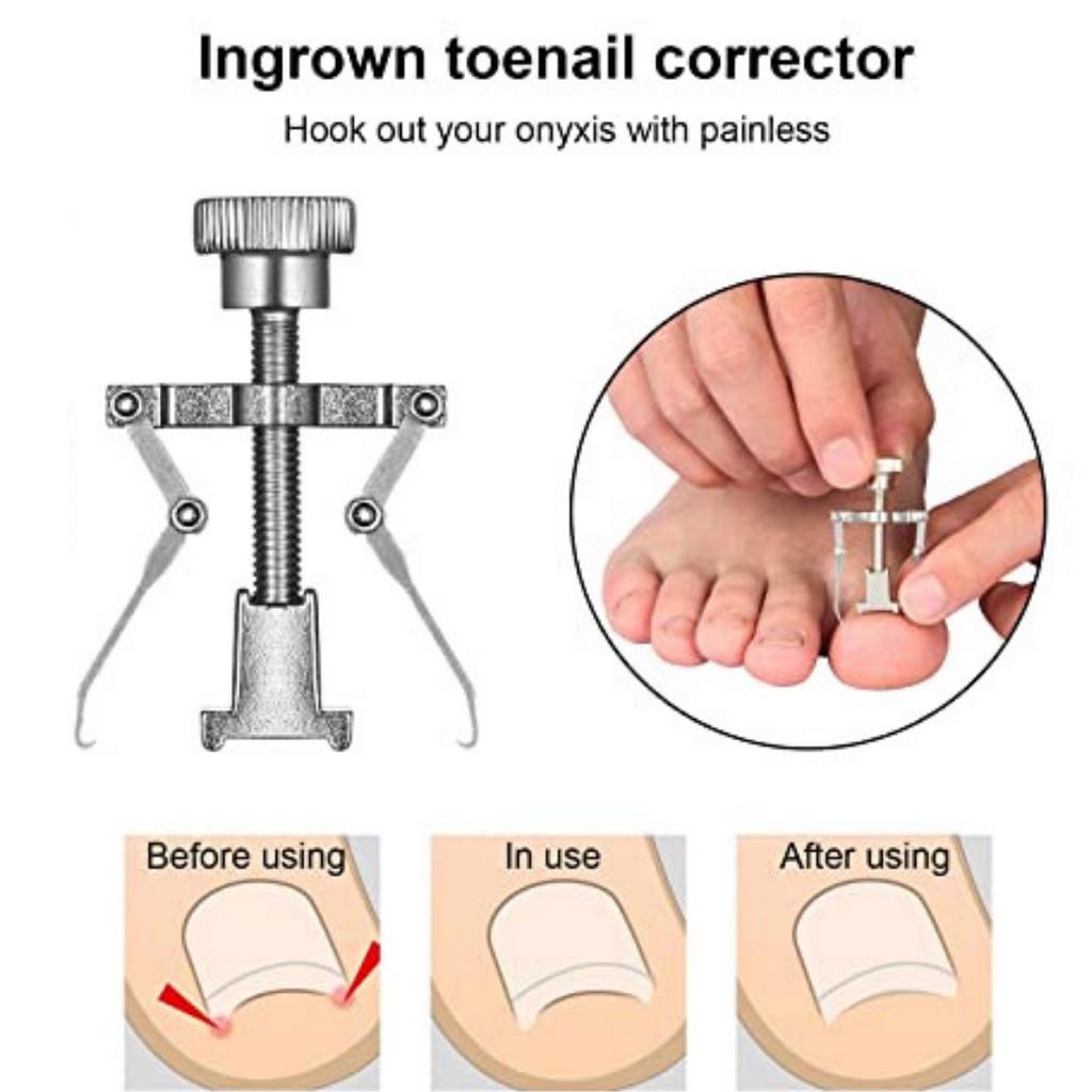 𝗦𝗼𝗼𝗹𝗲 𝘀𝗼𝗳𝘁. Ingrown Toenail Corrector Toe Nail Clipper Fixer Remover ...