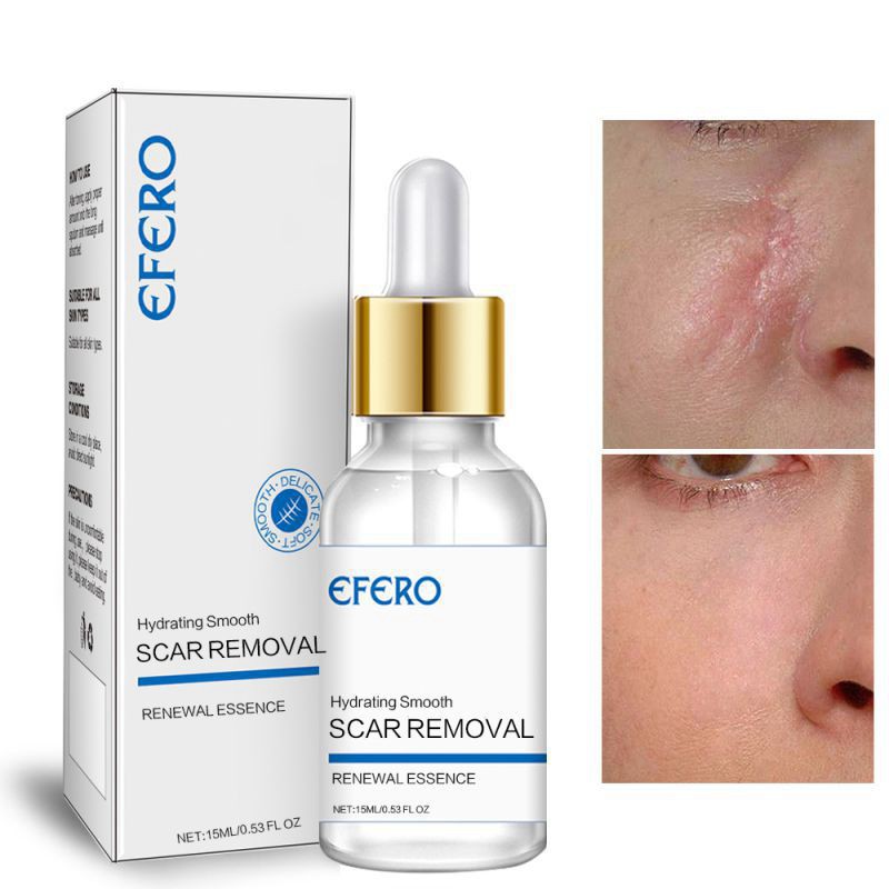 exo ღ Scar Removal Liquid Remove Scar Acne Mark Stretch Marks Scar
